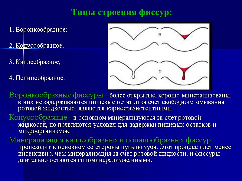 Типы строения фиссур:   1. Воронкообразное;   2. Конусообразное;   3.